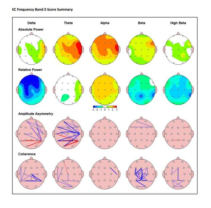 brain map after neurofeedback treatment for adhd